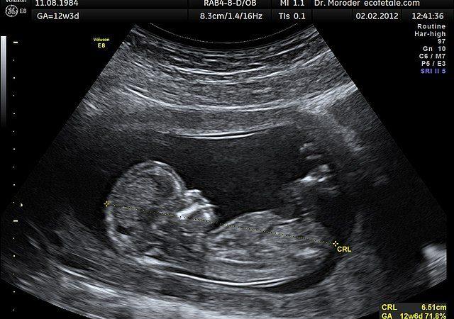 سونوگرافی چیست؟ - تصویر شاخص